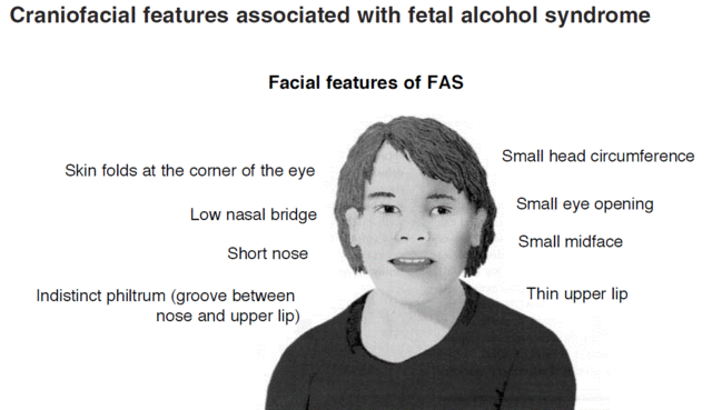 Symptoms of Fetal Alcohol Syndrome