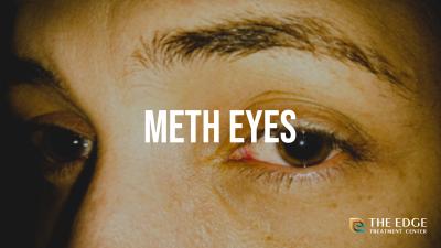 Ever hear of meth eyes? It's a dangerous (and perhaps permanent) complication of meth abuse. Learn more about meth eyes in our blog.
