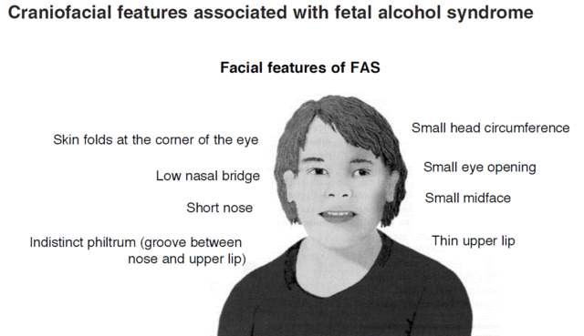 Fetal Alcohol Syndrome: Signs & Symptoms